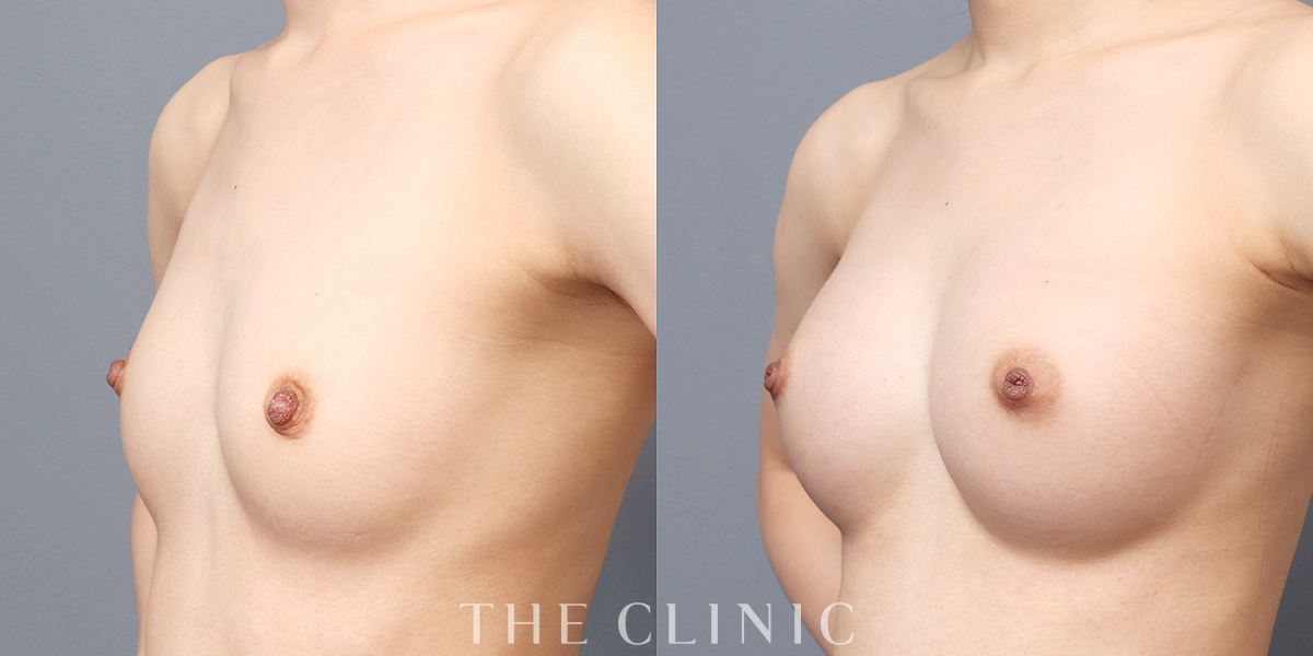 コンデンスリッチ豊胸の術前／術後