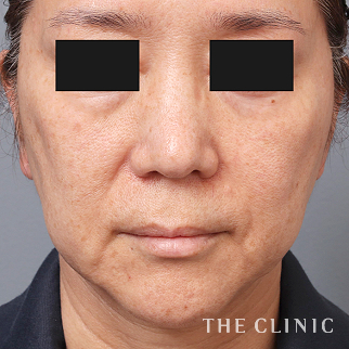 【THE CLINIC 症例画像】No.1438_1_マリオネットライン_マイクロCRF注入(顔の脂肪注入)(執刀医:帯包 雄次郎)