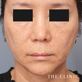 【THE CLINIC 症例画像】No.1438_2_マリオネットライン_マイクロCRF注入(顔の脂肪注入)(執刀医:帯包 雄次郎)