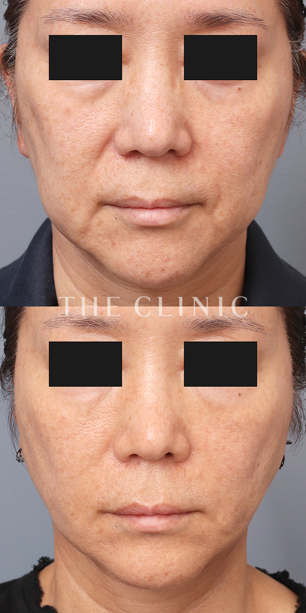 マリオネットラインのマイクロCRF注入(顔の脂肪注入)（58歳女性）の術前・術後写真