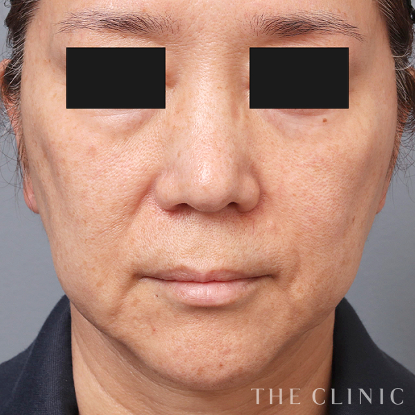 マリオネットラインのマイクロCRF注入(顔の脂肪注入)（58歳女性）の術前写真