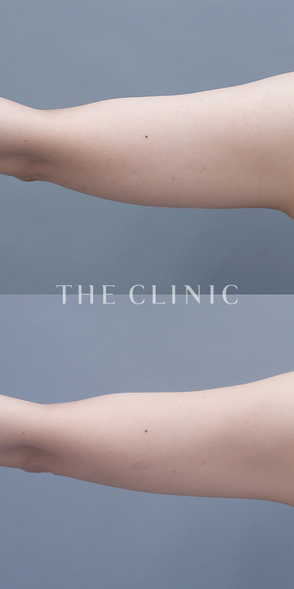 二の腕のベイザー脂肪吸引（39歳女性）の術前・術後写真