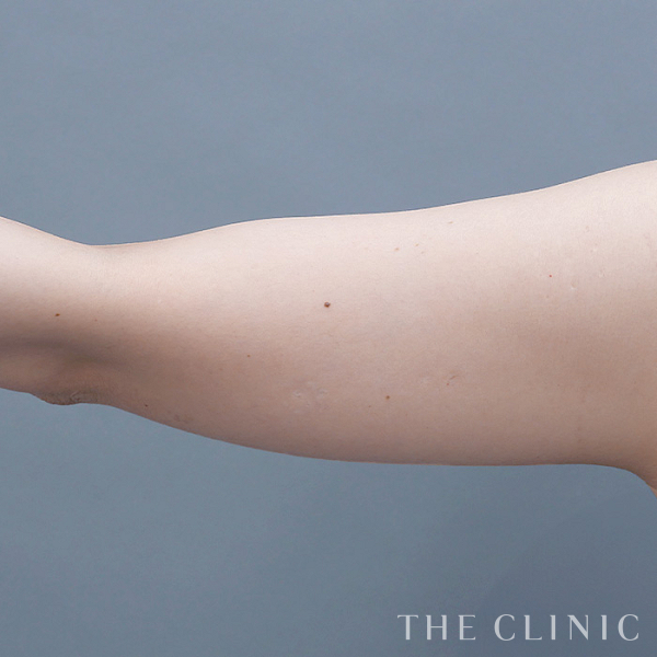 二の腕のベイザー脂肪吸引（39歳女性）の術前写真