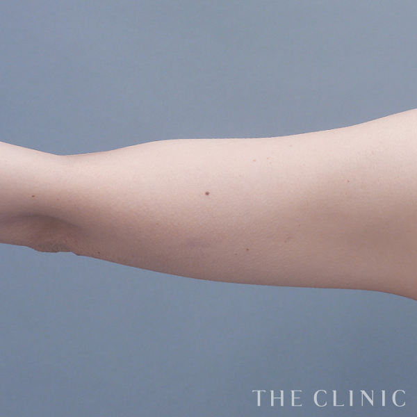 二の腕のベイザー脂肪吸引（39歳女性）の術後写真