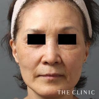 【THE CLINIC 症例画像】No.143_1_法令線_3Dセルリフト(切らないフェイスリフト)(執刀医：)