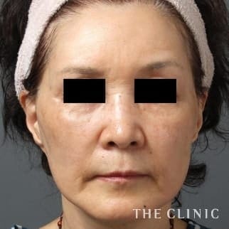 【THE CLINIC 症例画像】No.143_2_法令線_3Dセルリフト(切らないフェイスリフト)(執刀医：)