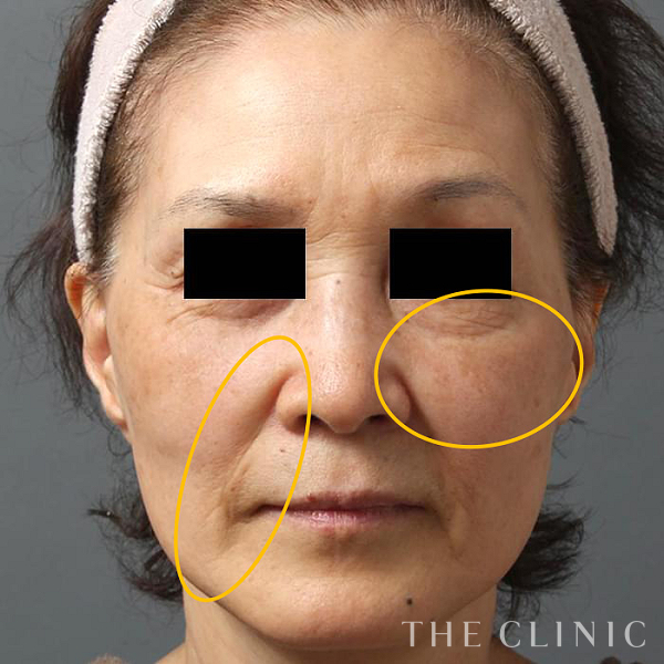 法令線の3Dセルリフト(切らないフェイスリフト)（65歳女性）の術前写真