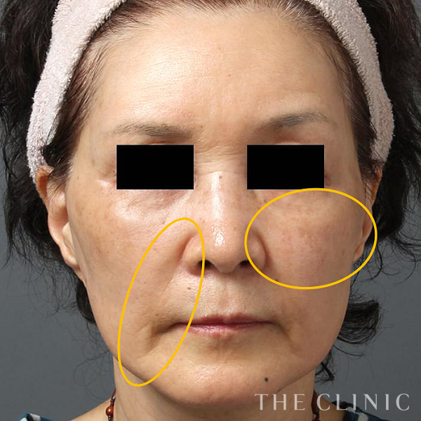 法令線の3Dセルリフト(切らないフェイスリフト)（65歳女性）の術後写真