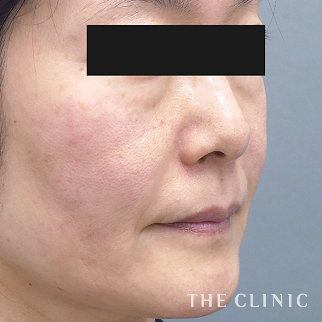 【THE CLINIC 症例画像】No.1440_1_目の下のクマ_SRF注入(顔の脂肪注入)(執刀医：木村 圭吾)