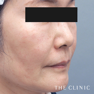 【THE CLINIC 症例画像】No.1440_2_目の下のクマ_SRF注入(顔の脂肪注入)(執刀医:木村 圭吾)