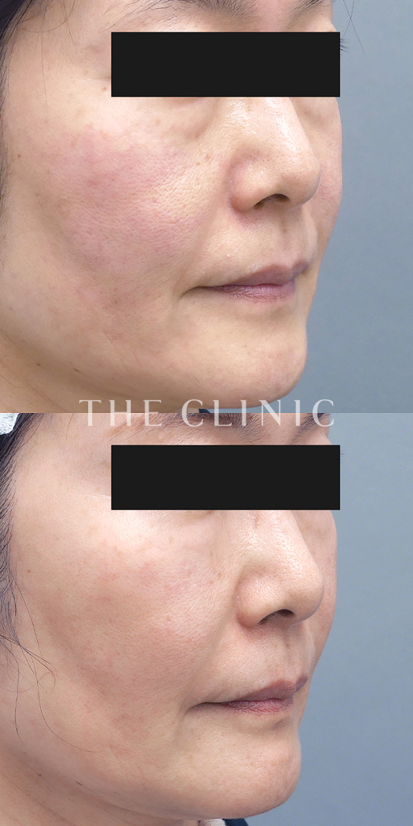 目の下のクマのSRF注入(顔の脂肪注入)（57歳女性）の術前・術後写真