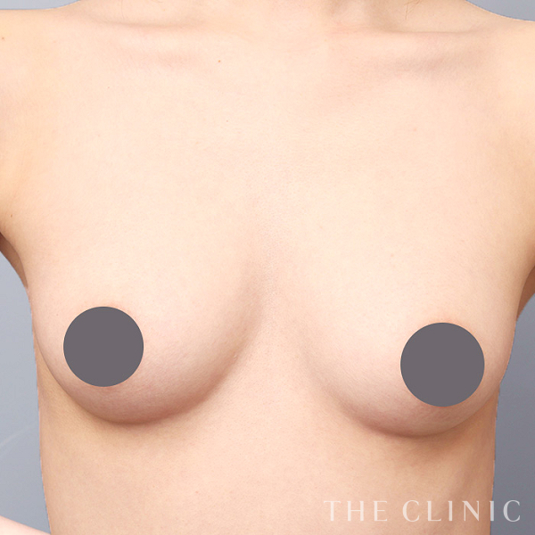 ボリュームアップのコンデンスリッチ豊胸（25歳女性）の術前写真