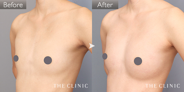 豊胸・胸の整形 ボリュームアップ 症例写真