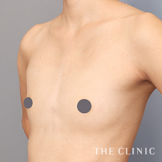 【THE CLINIC 症例画像】No.1444_1_ボリュームアップ_コンデンスビブラ豊胸(執刀医：大橋 昌敬)