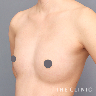 【THE CLINIC 症例画像】No.1444_2_ボリュームアップ_コンデンスビブラ豊胸(執刀医:大橋 昌敬)