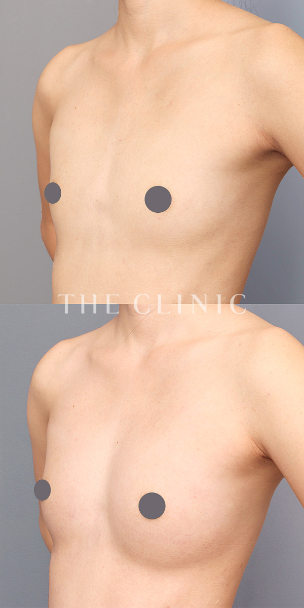 ボリュームアップのコンデンスビブラ豊胸（23歳女性）の術前・術後写真