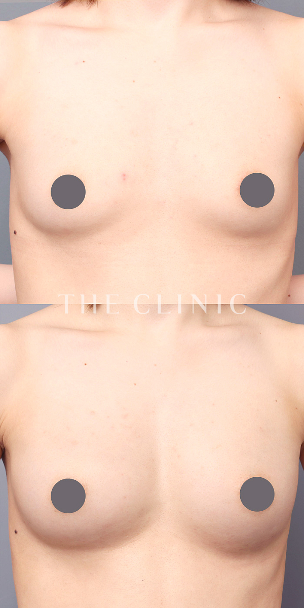 ボリュームアップの上向きバスト豊胸（27歳女性）の術前・術後写真