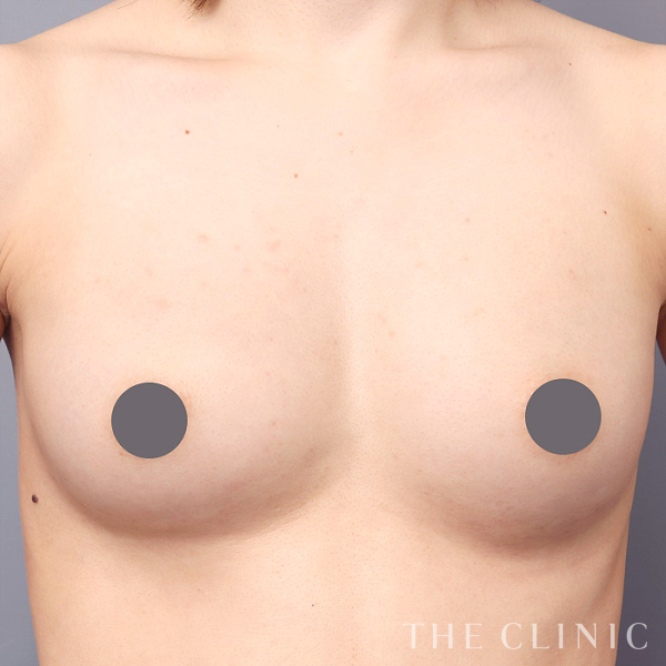 ボリュームアップの上向きバスト豊胸（27歳女性）の術後写真