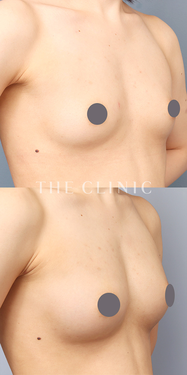 ボリュームアップの上向きバスト豊胸（27歳女性）の術前・術後写真