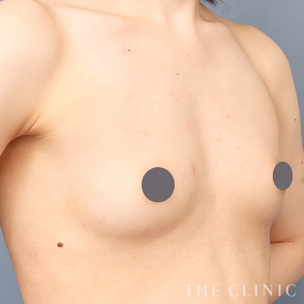 ボリュームアップの上向きバスト豊胸（27歳女性）の術前写真