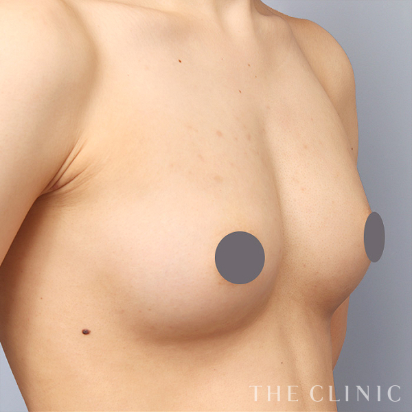 ボリュームアップの上向きバスト豊胸（27歳女性）の術後写真