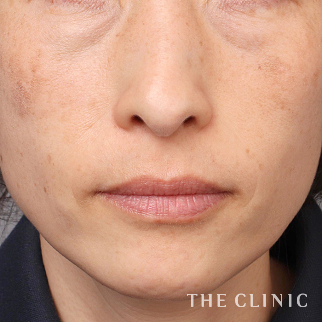 【THE CLINIC 症例画像】No.1447_1_目の下のクマ_コンデンスリッチフェイス(顔の脂肪注入)(執刀医:帯包 雄次郎)