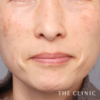 【THE CLINIC 症例画像】No.1447_2_目の下のクマ_コンデンスリッチフェイス(顔の脂肪注入)(執刀医：帯包 雄次郎)