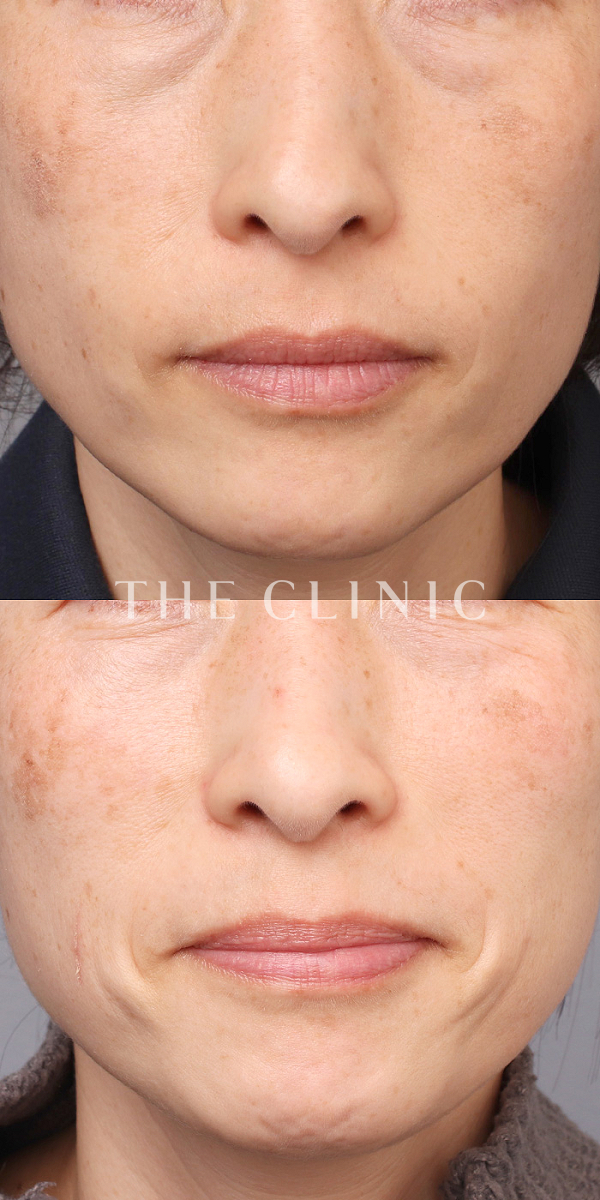 目の下のクマのコンデンスリッチフェイス(顔の脂肪注入)（42歳女性）の術前・術後写真