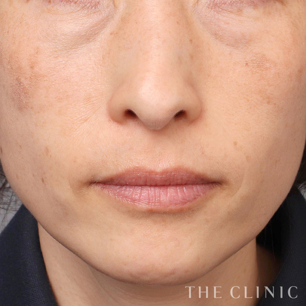 目の下のクマのコンデンスリッチフェイス(顔の脂肪注入)（42歳女性）の術前写真