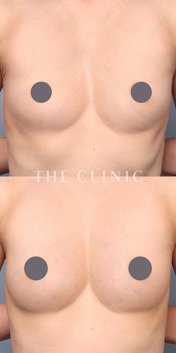 ボリュームアップのコンデンスリッチ豊胸（46歳女性）の術前・術後写真