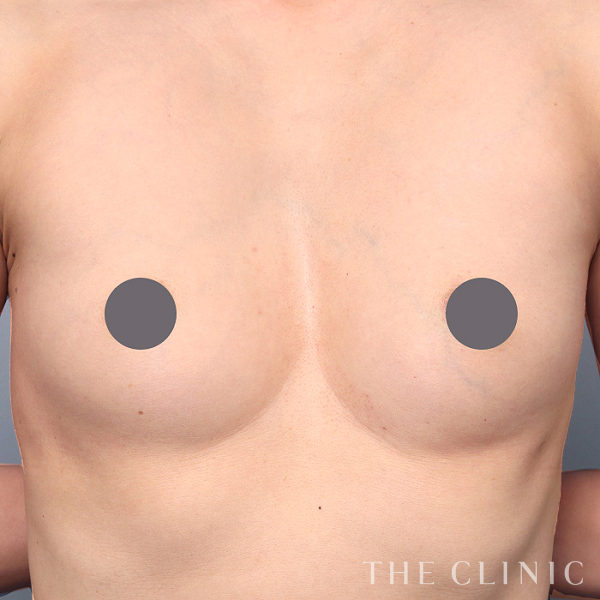 ボリュームアップのコンデンスリッチ豊胸（46歳女性）の術前写真