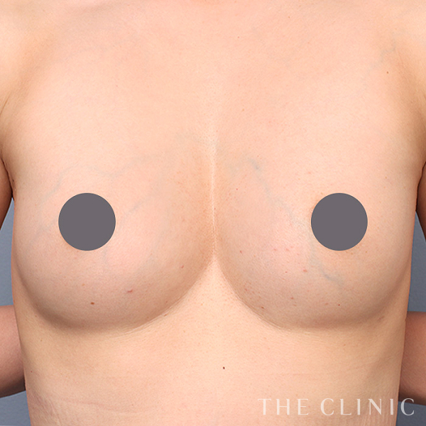 ボリュームアップのコンデンスリッチ豊胸（46歳女性）の術後写真