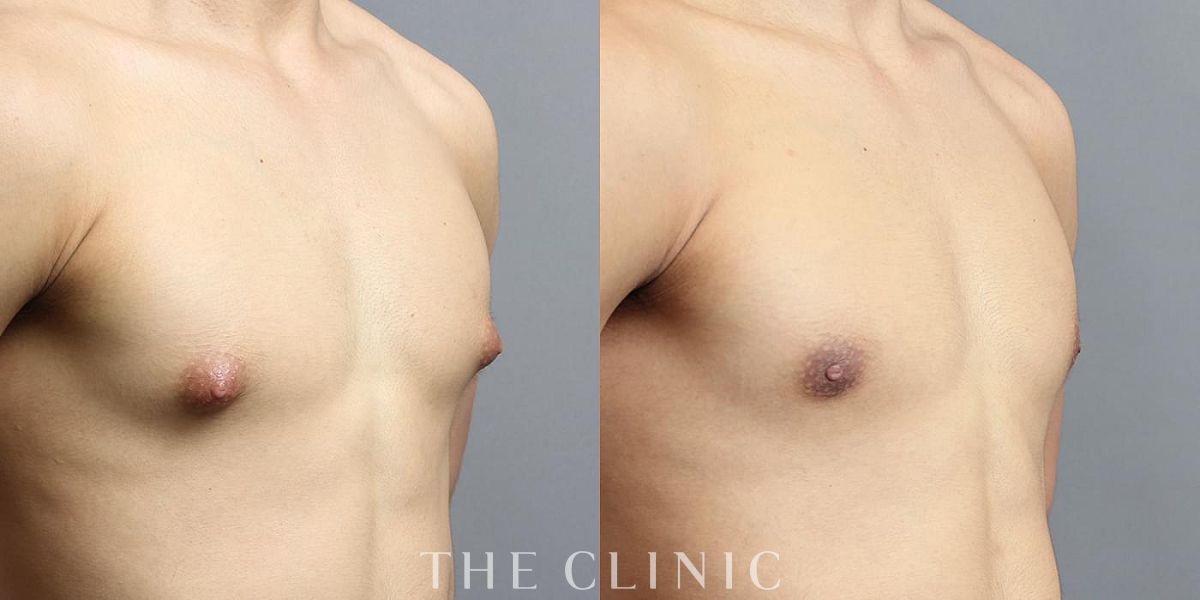 女性化乳房治療(男性の胸の膨らみ改善)の術前/術後