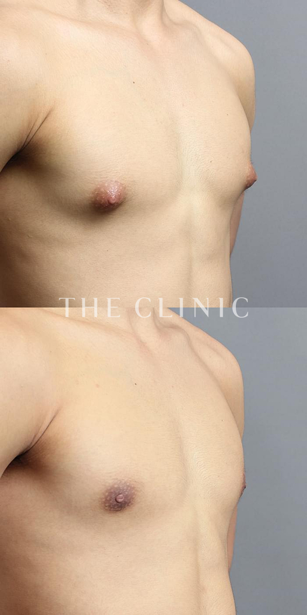 女性化乳房・真性女性化乳房の女性化乳房治療(男性の胸の膨らみ改善)（19歳男性）の術前・術後写真