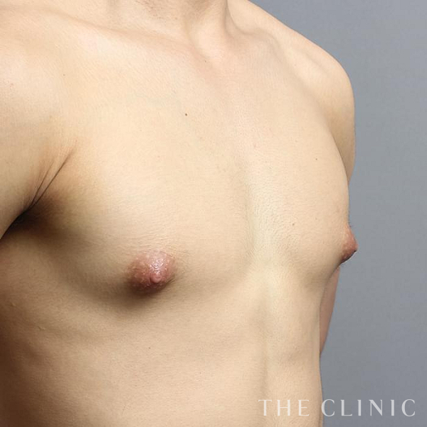 女性化乳房・真性女性化乳房の女性化乳房治療(男性の胸の膨らみ改善)（19歳男性）の術前写真