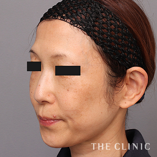 【THE CLINIC 症例画像】No.1450_1_おでこ(額)のくぼみ_コンデンスリッチフェイス(顔の脂肪注入)