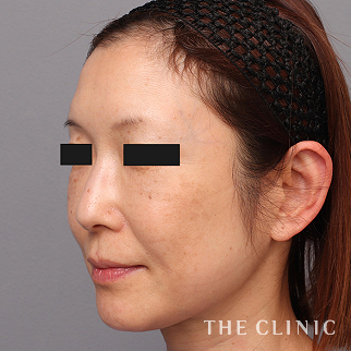 おでこ(額)のくぼみのコンデンスリッチフェイス(顔の脂肪注入)のモニター(50代)術後症例画像