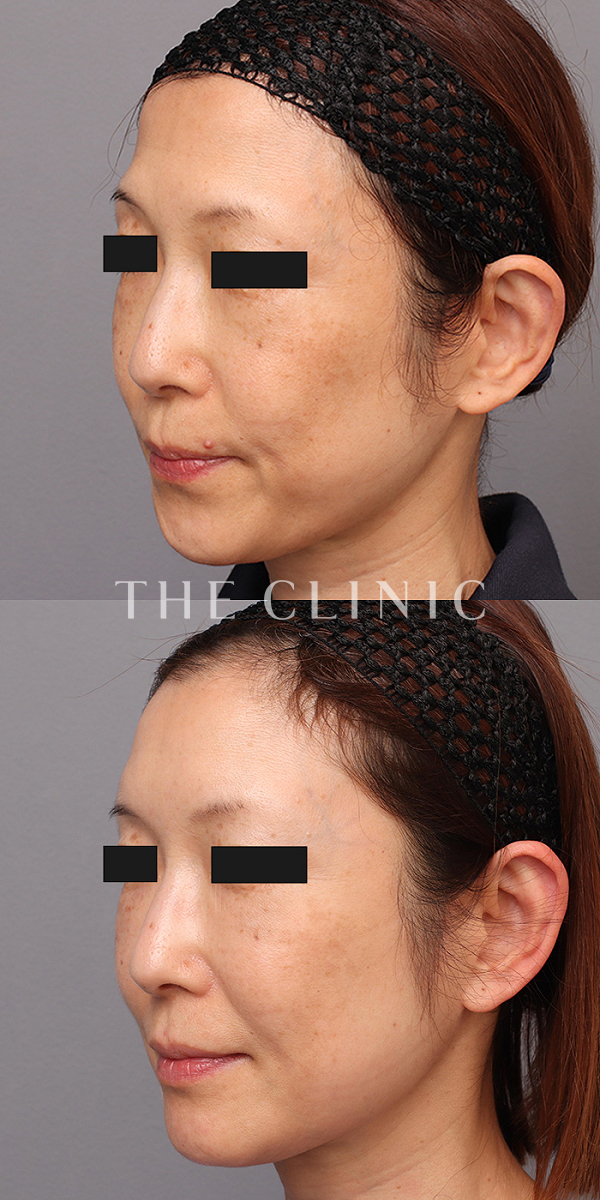 おでこ(額)のくぼみのコンデンスリッチフェイス(顔の脂肪注入)（55歳女性）の術前・術後写真