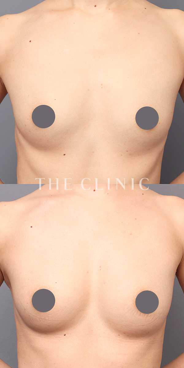 ボリュームアップのコンデンスリッチ豊胸（40歳女性）の術前・術後写真