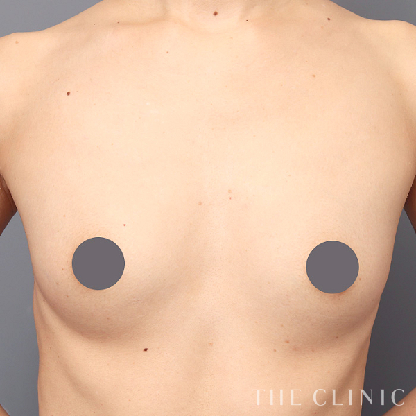 ボリュームアップのコンデンスリッチ豊胸（40歳女性）の術前写真