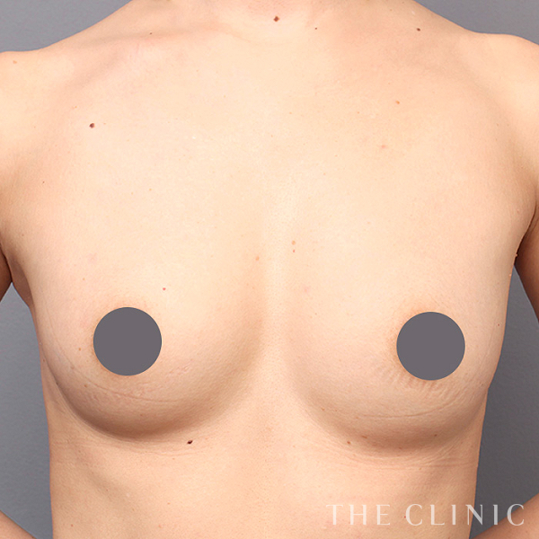 ボリュームアップのコンデンスリッチ豊胸（40歳女性）の術後写真