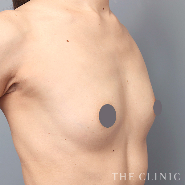 ボリュームアップのコンデンスリッチ豊胸（40歳女性）の術前写真