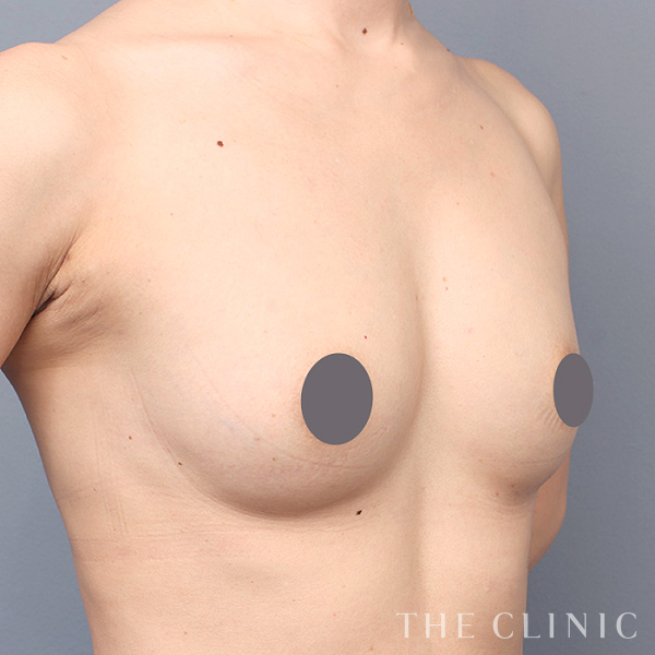 ボリュームアップのコンデンスリッチ豊胸（40歳女性）の術後写真