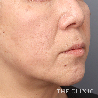 【THE CLINIC 症例画像】No.1454_2_頰/顎_ベイザー脂肪吸引(執刀医:志田 雅明)