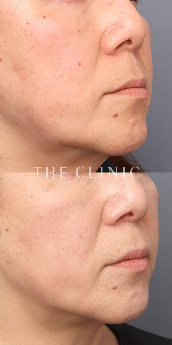 頰／顎のベイザー脂肪吸引（57歳女性）の術前・術後写真