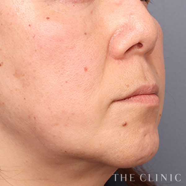 頰／顎のベイザー脂肪吸引（57歳女性）の術前写真