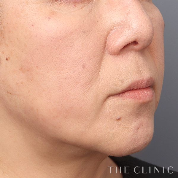 頰／顎のベイザー脂肪吸引（57歳女性）の術後写真