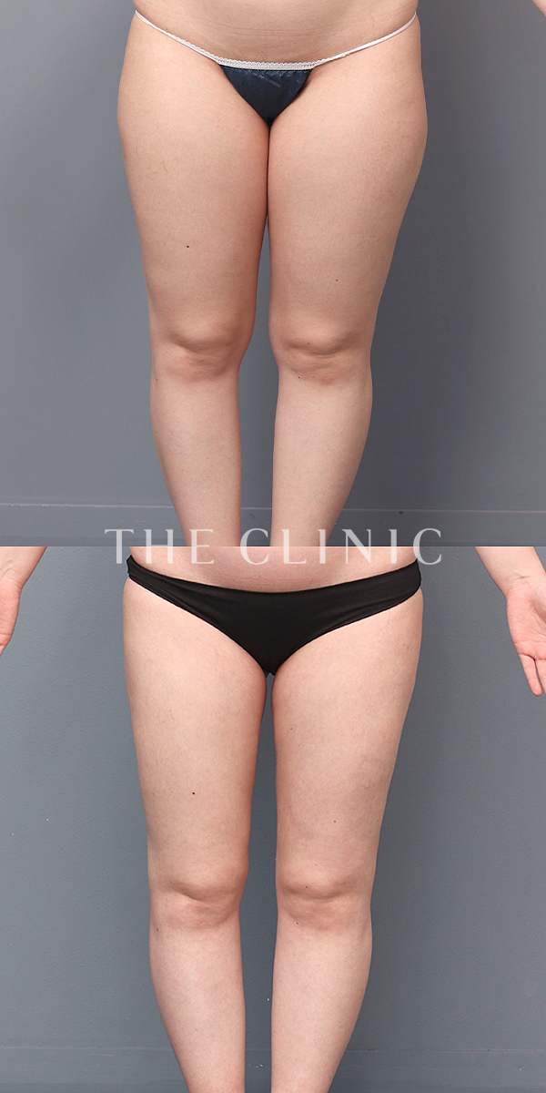太もものベイザー脂肪吸引（27歳女性）の術前・術後写真