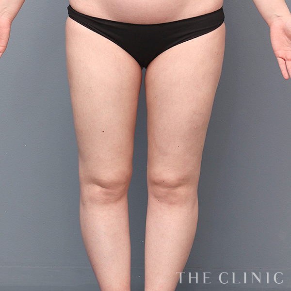 太もものベイザー脂肪吸引（27歳女性）の術後写真