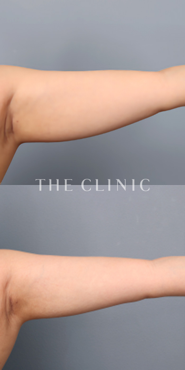 二の腕のベイザー脂肪吸引（34歳女性）の術前・術後写真